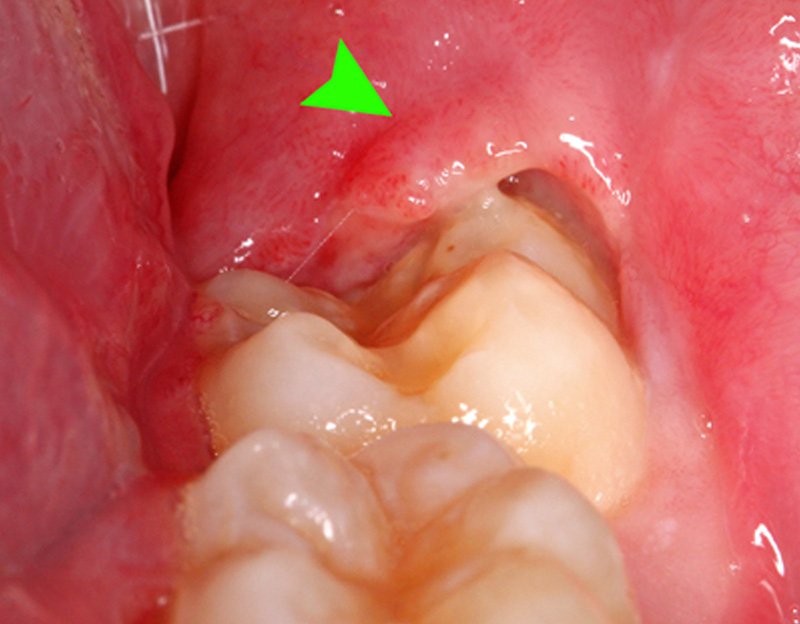 智齿从牙龈线向外突出致组织发炎